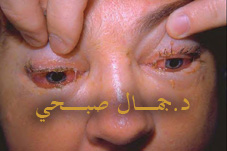 حول التهاب الحجاج 
Orbital Cellulitis