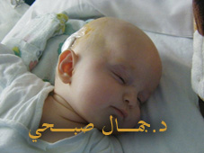 حول استسقاء المخ
Hydrocephalus